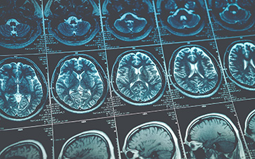 Brain Tumor Diagnosis: Benefits of MRI Technology